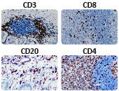 TIL antibody panel used for IHC-P analysis of CD3, CD4, CD8, and CD20 in FFPE human lymphoid tissues, demonstrating immune cell infiltration in the tumor microenvironment.
