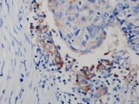 Immunohistochemistry (IHC-P) staining of human lung adenocarcinoma tissue showing PD-L1 (CD274) expression in formalin-fixed paraffin-embedded sections using anti-PD-L1 antibody, with Tris-EDTA antigen retrieval (pH 9.0).