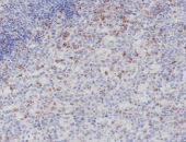 Immunohistochemistry (IHC-P) staining of human lymphoma tissue showing CTLA-4 (CD152) expression in formalin-fixed paraffin-embedded sections using anti-CTLA-4 antibody, with Tris-EDTA antigen retrieval (pH 9.0).