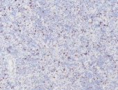 Immunohistochemistry (IHC-P) staining of human lymphoma tissue using anti-CD223 / LAG-3 antibody [SQab22258], FFPE section with Tris-EDTA antigen retrieval (pH 9.0).