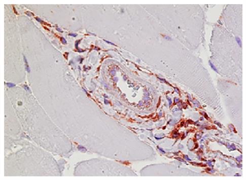 Immunohistochemistry: Paraffin-embedded Mouse adductor muscle day 7 post femoral artery ligation was stained with anti-Mac-3 followed by ARG23770 Goat anti-Rat IgG (H+L) antibody (Biotin) (pre-adsorbed) and then ARG23912 Streptavidin (HRP), hematoxylin, and AEC.