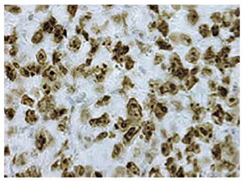 Immunohistochemistry: Paraffin-embedded NB-9464 induced Mouse tumor tissue was stained with ARG23768 Goat anti-Rabbit IgG (H+L) antibody (HRP), pre-adsorbed.